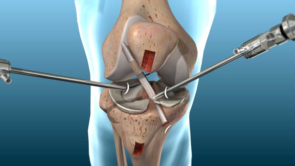 ACL Surgeon