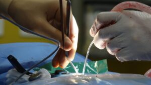 Knee Replacement Surgery
