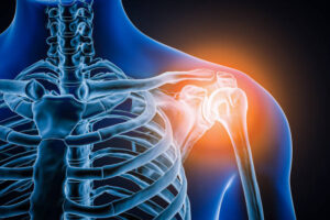 Shoulder replacement