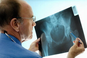 hip replacement surgeon